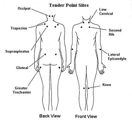 cbd for fibromyalgia reddit